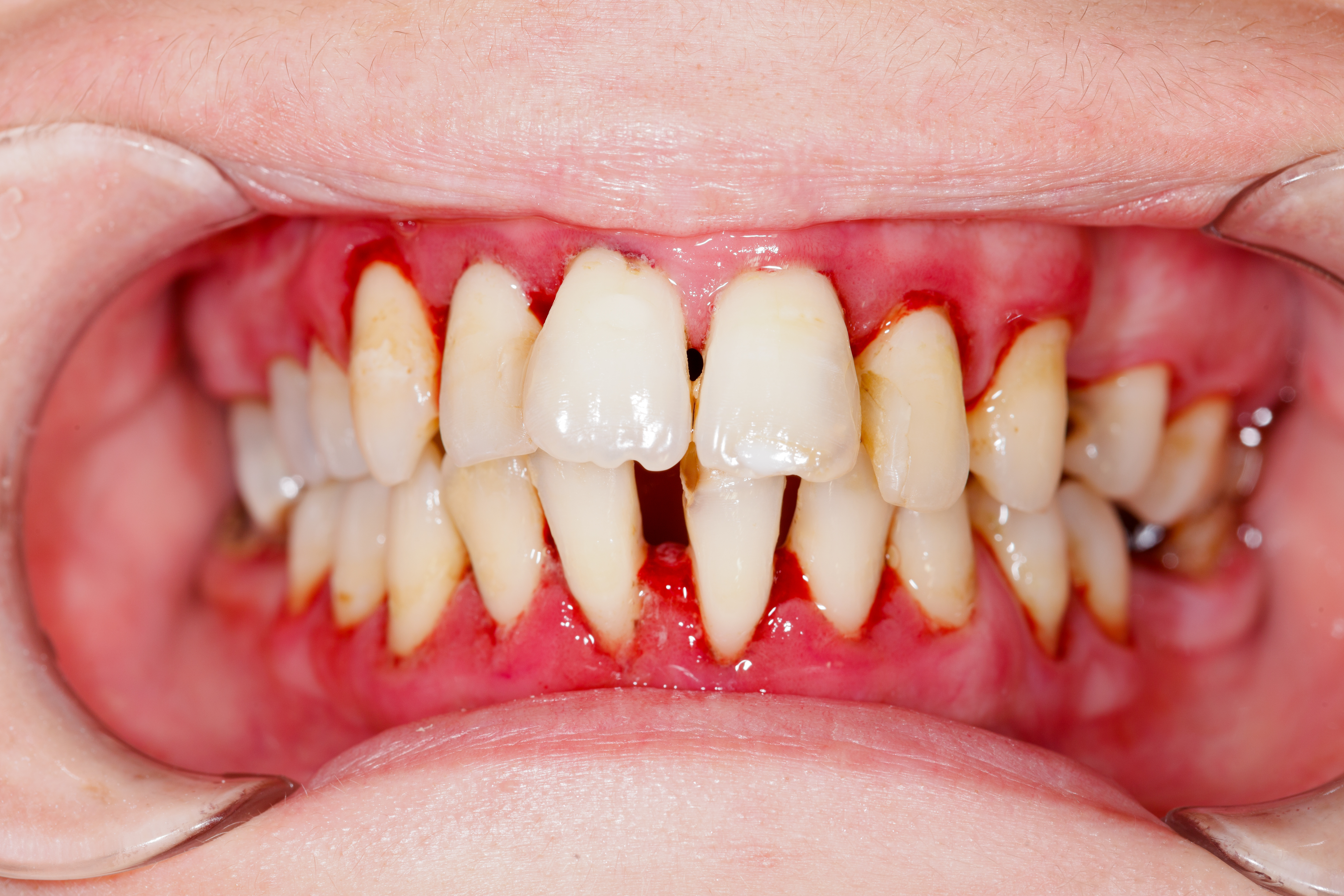 gum disease swollen gums